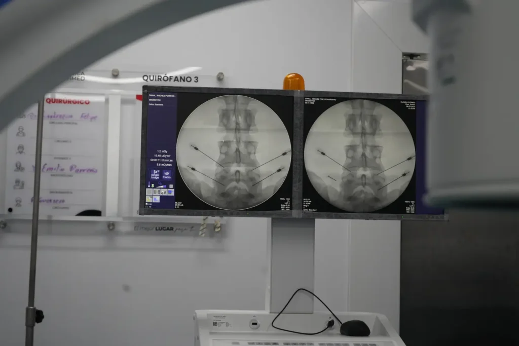 Qué es la inyección epidural para el dolor - inyección epidural Representación anatómica de la columna mostrando el área donde se aplica la inyección epidural-clinica del dolor