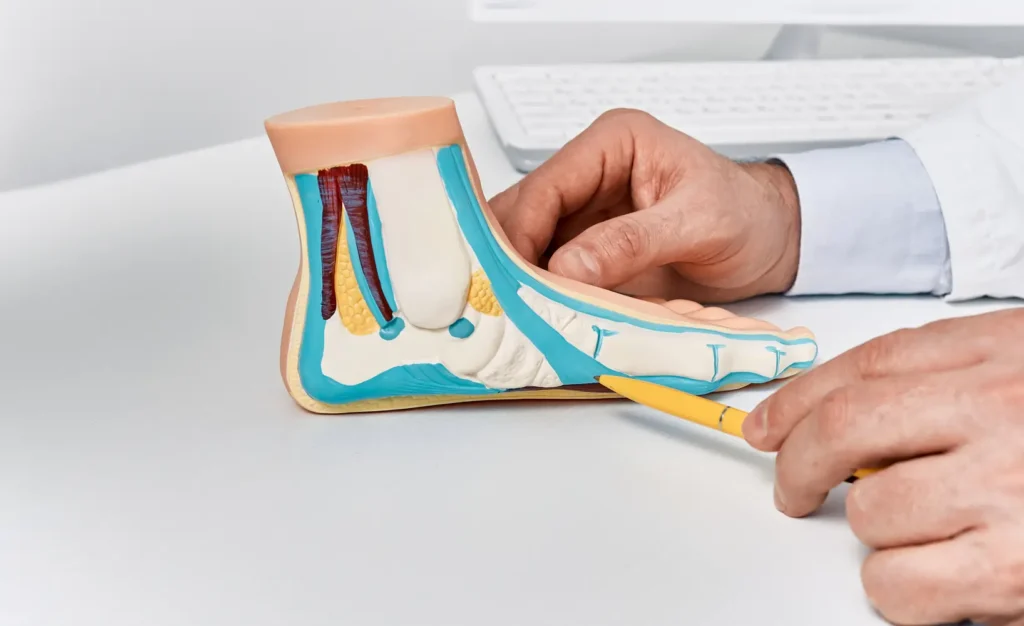 Descubre qué es la fascitis plantar y cómo tratarla eficazmente: causas, síntomas y ejercicios clave | qué es fascitis plantar imagen anatomica de fascitis plantar - clinica del dolor