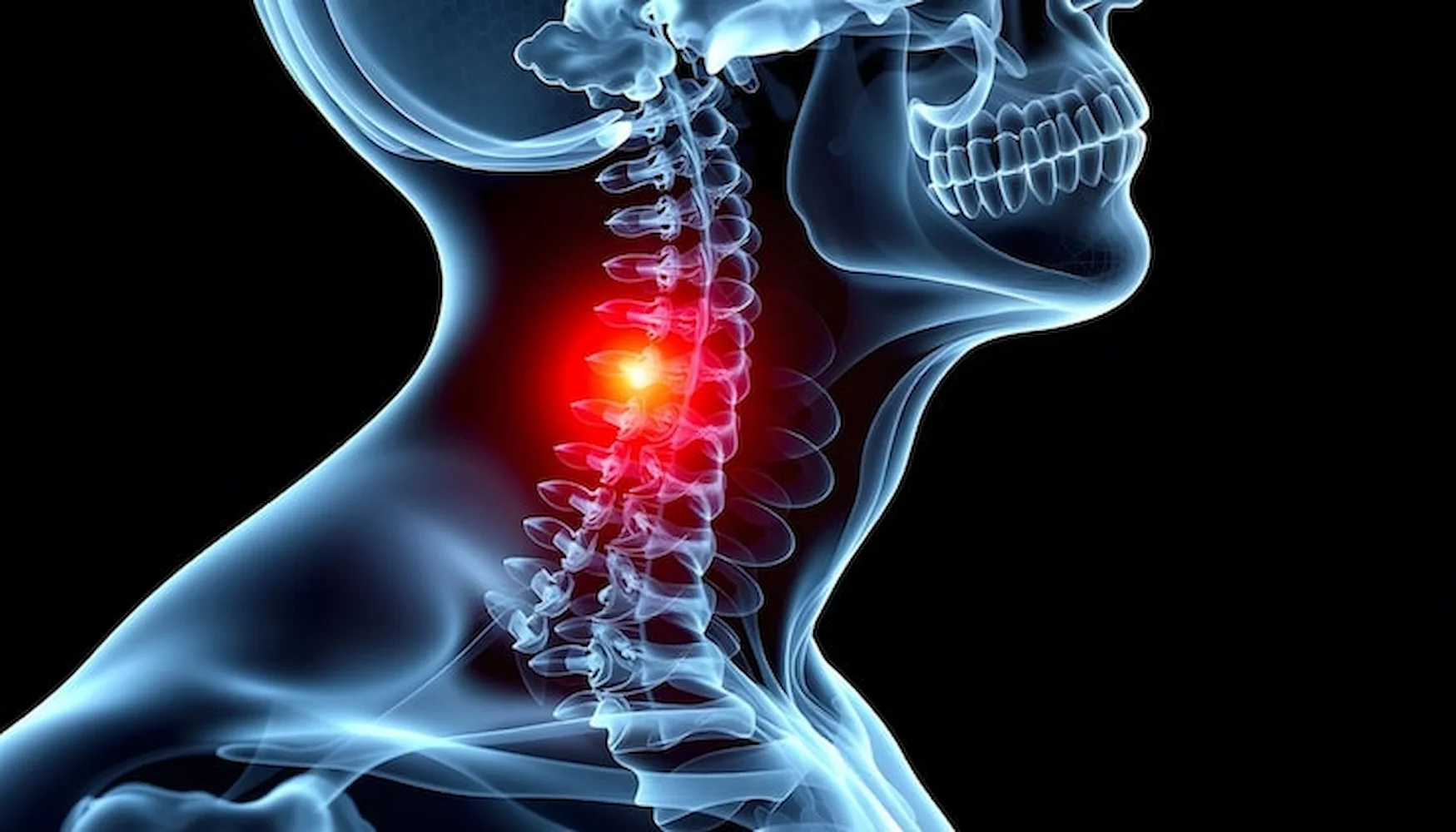 Cervicalgia que es y tratamientos - clinica del dolor